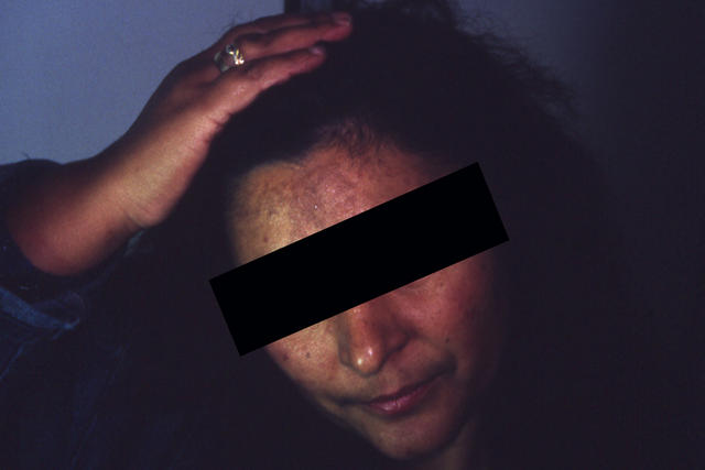 PIGMENTATION DISORDERS - Melasma