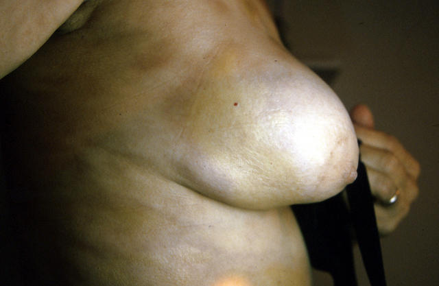 CONNECTIVE TISSUE DISORDERS - Morphea