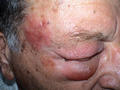 VIRAL INFECTIONS - Herpes Zoster