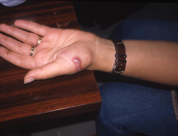 SOFT TISSUE TUMORS - Cheloid SOFT TISSUE TUMORS - Cheloid