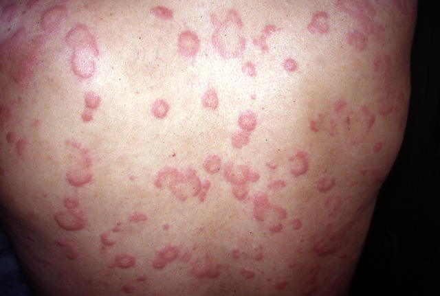 URTICARIA - Urticaria