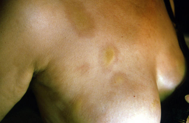 CONNECTIVE TISSUE DISORDERS - Morphea CONNECTIVE TISSUE DISORDERS - Morphea