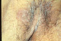SUPERFICIAL FUNGAL INFECTIONS - Vulvovaginal candidiasis