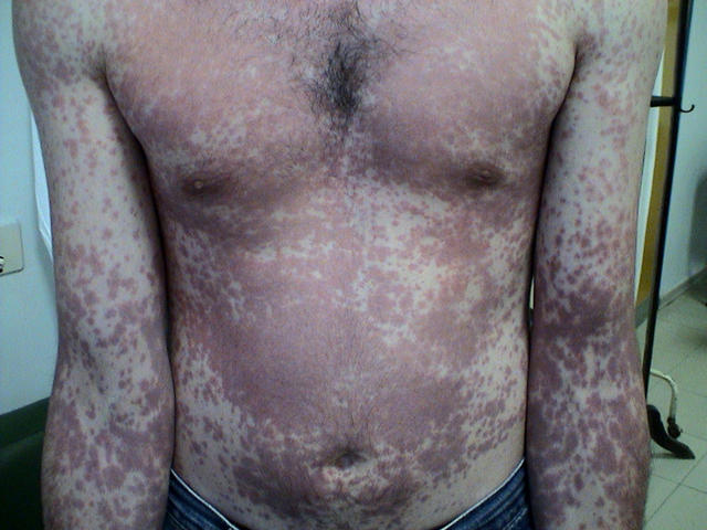 DRUG ERUPTIONS - Drug eruption DRUG ERUPTIONS - Drug eruption