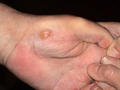 BULLOUS DISEASES - Bullous pemphigoid