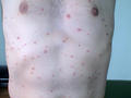 PSORIASIS - Guttate psoriasis