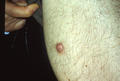 BENIGN SKIN LESIONS, NEVI, CYSTS - Dermatofibroma