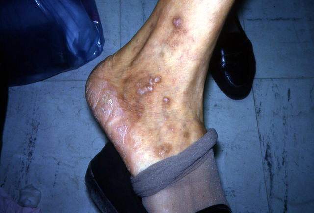 LICHEN - Lichen planus pigmentosus LICHEN - Lichen planus pigmentosus