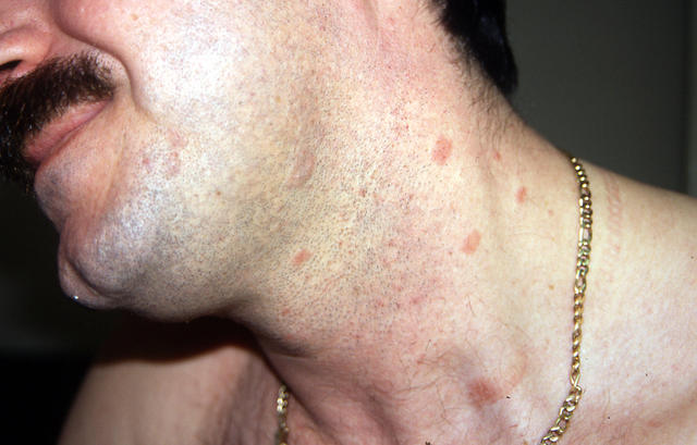 VARIOUS or of UNKNOWN ETIOLOGY DISEASES - Pityriasis rosea VARIOUS or of UNKNOWN ETIOLOGY DISEASES - Pityriasis rosea