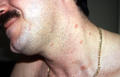 VARIOUS or of UNKNOWN ETIOLOGY DISEASES - Pityriasis rosea