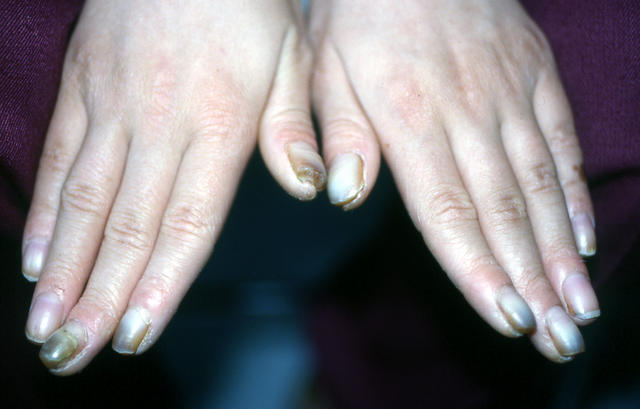 NAIL DISEASES - Pachyonychia congenita NAIL DISEASES - Pachyonychia congenita
