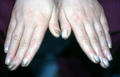 NAIL DISEASES - Pachyonychia congenita