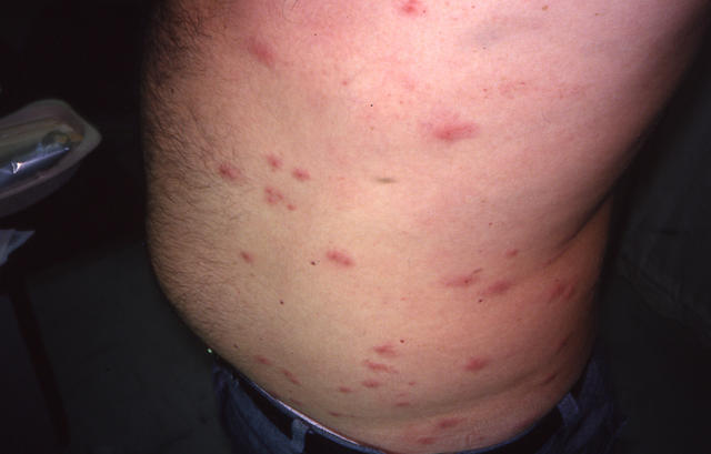 PARASITOSES, BITES - Insect bites PARASITOSES, BITES - Insect bites