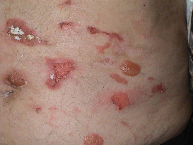 BULLOUS DISEASES - Bullous pemphigoid