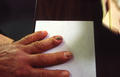 NAIL DISEASES - Onychomycosis