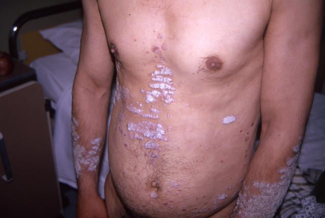 PSORIASIS - Plaque psoriasis