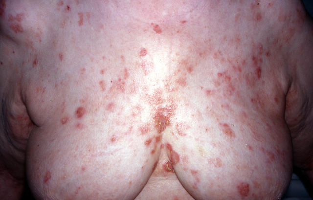 BULLOUS DISEASES - Pemphigus erythematosus BULLOUS DISEASES - Pemphigus erythematosus