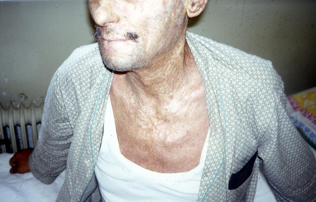 METABOLIC DISEASE, NUTRITION - Porphyria cutanea tarda METABOLIC DISEASE, NUTRITION - Porphyria cutanea tarda