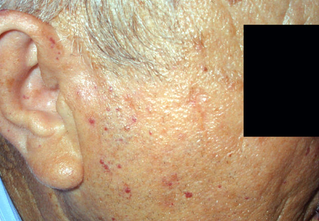 DISEASE OF THE BLOOD AND THE VESSELS – PURPURAS - Rendu - Osler disease