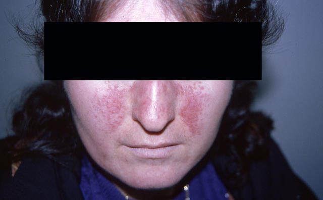 DISEASES OF THE SEBACEOUS GLANDS - Rosacea