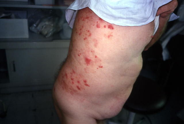 SUPERFICIAL FUNGAL INFECTIONS - Tinea infection, multiple lesions SUPERFICIAL FUNGAL INFECTIONS - Tinea infection, multiple lesions