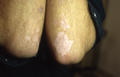 PIGMENTATION DISORDERS - Vitiligo