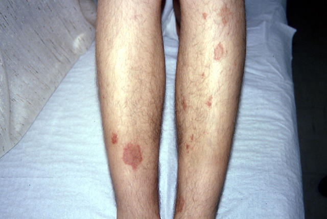 DISEASE OF THE BLOOD AND THE VESSELS – PURPURAS - Purpura, annular DISEASE OF THE BLOOD AND THE VESSELS – PURPURAS - Purpura, annular