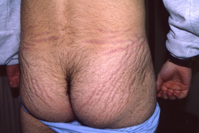 DRUG ERUPTIONS - Striae due to topical corticosteroids