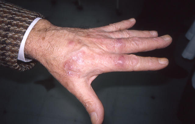 SUPERFICIAL FUNGAL INFECTIONS - Tinea