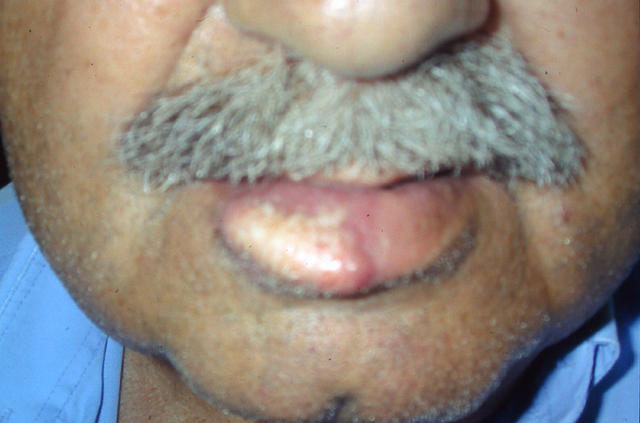 MALIGNANT LESIONS - Squamous Cell Carcinoma (SCC) of the lip MALIGNANT LESIONS - Squamous Cell Carcinoma (SCC) of the lip