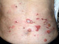 BULLOUS DISEASES - Bullous pemphigoid