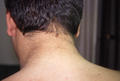 KERATINISATION DISORDERS - Acanthosis nigricans