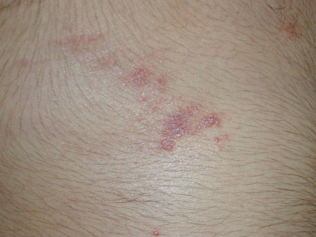 LICHEN - Lichen planus, annular LICHEN - Lichen planus, annular