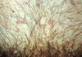 VIRAL INFECTIONS - Mollescum contagiosum