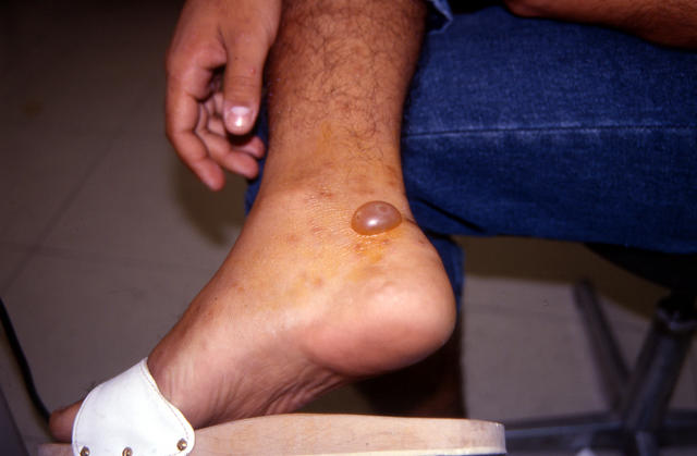PARASITOSES, BITES - Insect bites PARASITOSES, BITES - Insect bites