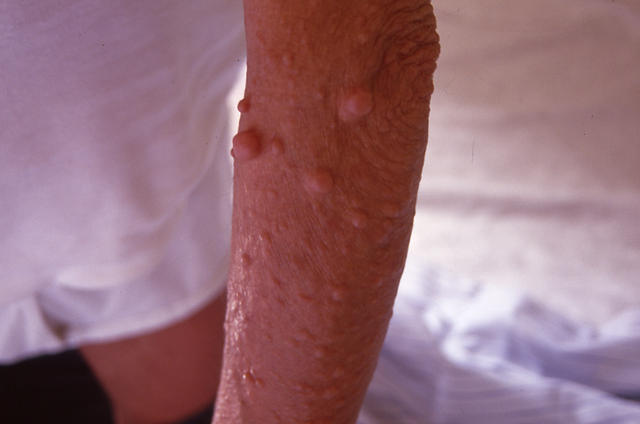 GENODERMATOSES - Neurofibromatosis (νon Recklinghausen's disease)