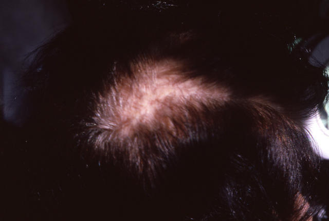 HAIR DISEASES - Alopecia cicatricial