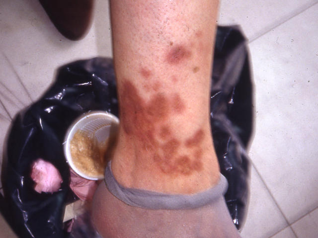 NECROBIOTIC DISORDERS - Necrobiosis lipoidica NECROBIOTIC DISORDERS - Necrobiosis lipoidica