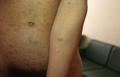 VARIOUS or of UNKNOWN ETIOLOGY DISEASES - Pityriasis rosea