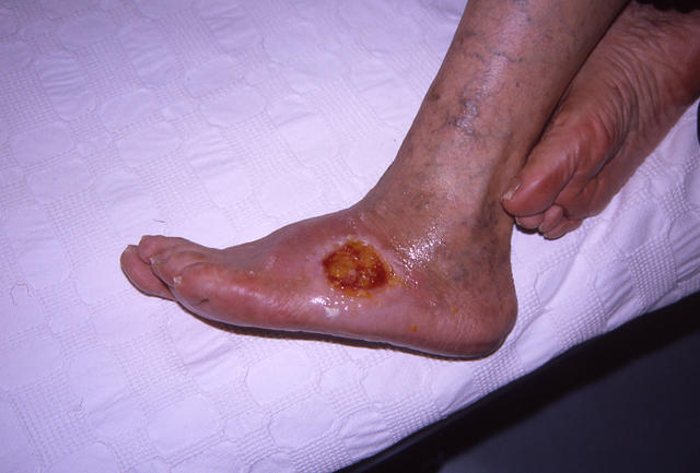 DISEASE OF THE BLOOD AND THE VESSELS – PURPURAS - Gravitational Ulcer