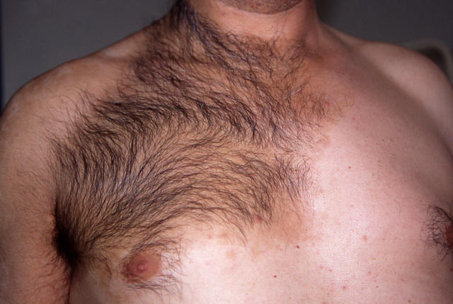 BENIGN SKIN LESIONS, NEVI, CYSTS - Becker's naevus BENIGN SKIN LESIONS, NEVI, CYSTS - Becker's naevus