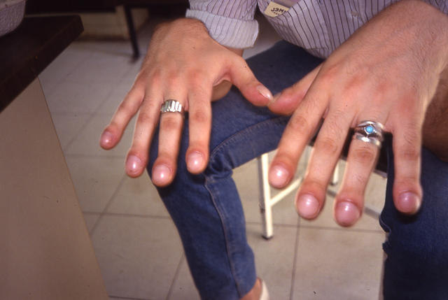 NAIL DISEASES - Clubbing NAIL DISEASES - Clubbing