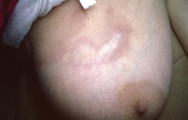 CONNECTIVE TISSUE DISORDERS - Morphea