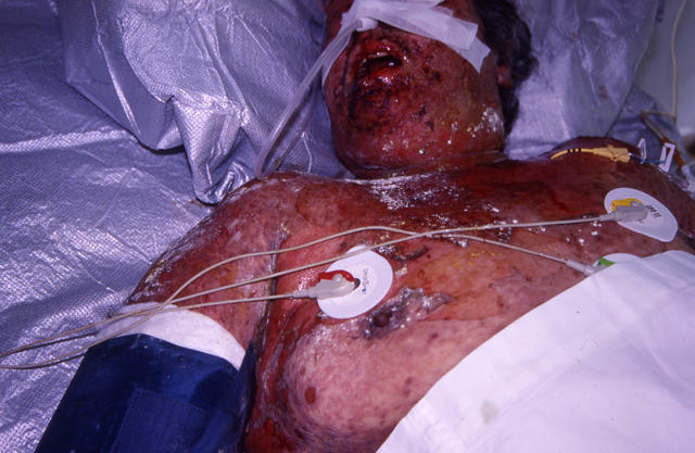 DRUG ERUPTIONS - Stevens - Johnson syndrome