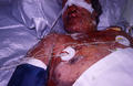 DRUG ERUPTIONS - Stevens - Johnson syndrome