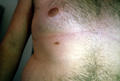 GENODERMATOSES - Supernumerary nipple