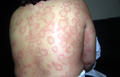 URTICARIA - Urticaria