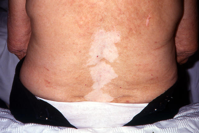 PIGMENTATION DISORDERS - Vitiligo PIGMENTATION DISORDERS - Vitiligo