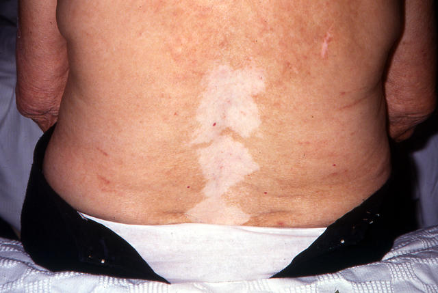 PIGMENTATION DISORDERS - Vitiligo