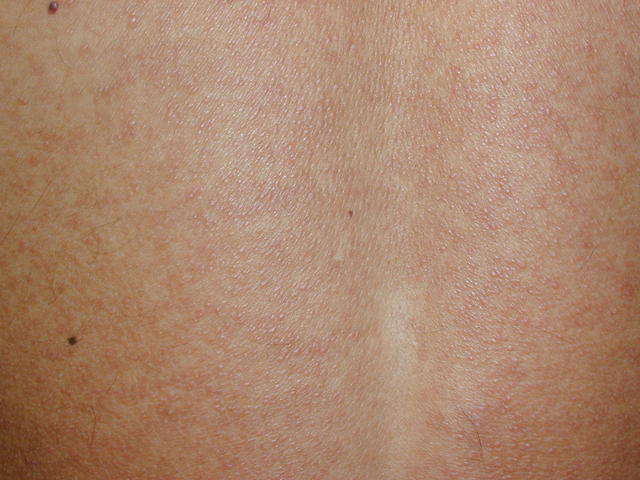 MASTOCYTOSES - Urticaria Pigmentosa